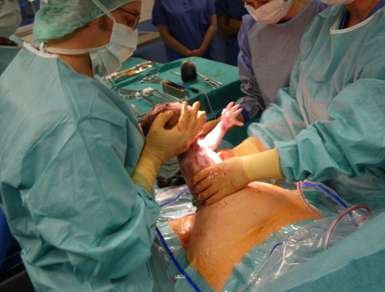 Herausziehen des Kindes beim Kaiserschnitt. Bild: HBR / wikipedia.org