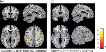 MRT-Aufnahmen des Gehirns: Stressinduzierte Gehirnaktivierung während dem Betrachten von Bildern von anderen Personen in schmerzvollen Situationen. Quelle: Copyright: Claus Lamm (2016). Published by Oxford University Press (idw)