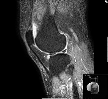 Reizerguss, NMR-Bild einer Kniearthrose im Längsschnitt.