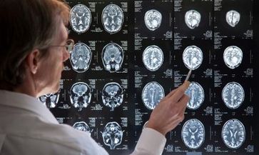 Anhand von Magnetresonanz-Tomographie-Aufnahmen fanden US-Wissenschaftler heraus, dass das Gehirn bei Menschen mit unbehandeltem Hörverlust schneller schrumpft als bei Personen mit normalem Gehör. Bild: "obs/Foto: audibene, iStock / stanley45"