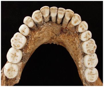 Gut erhaltener Unterkiefer des Neandertalers Regourdou 1
Quelle: © P. Sémal, Royal Belgian Institute of Natural Sciences Brussels (idw)