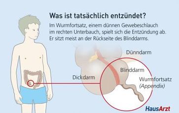 Nicht der Blinddarm selbst, sondern der Wurmfortsatz, ein Anhängsel an seiner Rückseite, ist bei einer Entzündung betroffen. Grafik: obs/HausArzt-PatientenMagazin