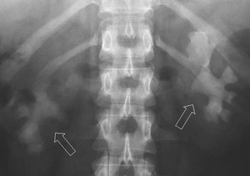 Röntgenaufnahme. Extreme Steinbildung in beiden Nieren. Beide Nierenhohlräume wurden innerhalb eines Jahres nahezu vollständig von Steinmaterial ausgefüllt ("Ausgußsteine"). (c) Urologische Klinik der Uniklinik Bonn