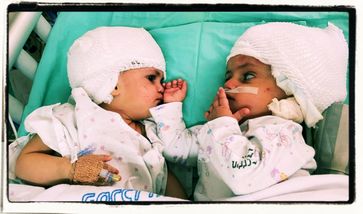 Siamesische Zwillinge nach 12-stündiger Operation in Israel erfolgreich voneinander getrennt