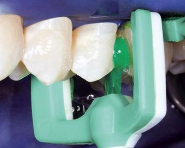 Beginnende Karies kann jetzt mit einer revolutionären Methode ohne Bohren behandelt werden, indem der Zahnschmelz mit einem speziellen flüssigen Kunststoff aufgefüllt wird. Bild: Dental Material Gesellschaft (DMG)