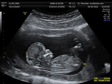 Sonografische Aufnahme eines Fötus mit 12 Schwangerschaftswochen