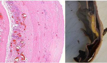 Ein Riss in der Wand der Aorta, gesäumt von Ansammlungen von Lymphozyten, der zu einer Aortenruptur (Schlagader-Riss) führt. (Michael Palmer, MD, Sucharit Bhakdi, MD)