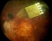 Subretinales Chip-Implantat Bildquelle: Retina Implant GmbH