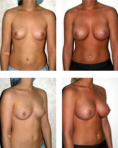 Brustvergrößerung: vor- und nachher