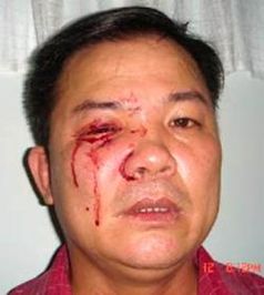 Pastor Nguyen Cong Chinh nach Misshandlung durch vietnamesische Polizisten der Religionsabteilung PA38 am 12. Juli 2008