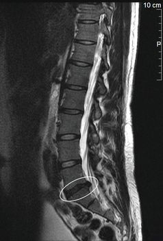MRT-Aufnahme eines Bandscheibenvorfalls in der Lendenwirbelsäule