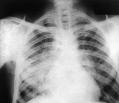 Röntgenbild: Alternative Untersuchungsmethode in Sicht. Bild: CDC/ Dr. P. Brachman
