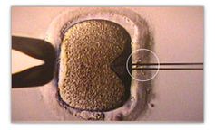 Intrazytoplasmatische Spermieninjektion an einer Eizelle