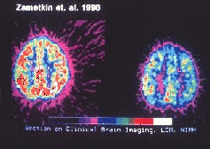 In einer 1990 von Zametkin und Mitarbeitern durchgeführten Studie wurde der Glucose-Stoffwechsel des Gehirns bei erwachsenen ADHS-Patienten und gesunden Kontrollpersonen verglichen. Die PET-Aufnahme zeigt links den zerebralen Glukoseverbrauch einer Person ohne ADS und rechts einer Person mit ADS bei einer bestimmten Aufgabenstellung. Die Studie war die erste große funktionell-bildgebende Untersuchung zur ADHS und bildete die Grundlage für viele weitere Studien. Die spezifischen Befunde konnten in nachfolgenden Studien allerdings nur teilweise reproduziert werden.