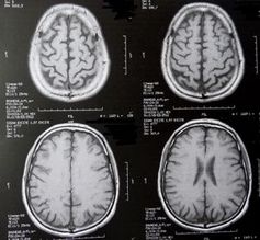 Gescanntes Gehirn: Entzündung schädigt stark. Bild: pixelio.de/Dieter Schütz