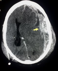 CT-Bild einer durch Schütteln verursachten Hirnblutung (Pfeil) zwischen Hirnhaut und Gehirn.