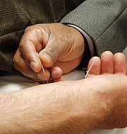 Akupunktur Bild: en.wikipedia.org