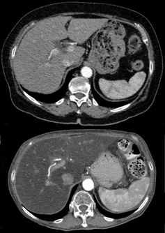 Ausgeprägte Fettleber in der Computertomographie (unten) im Vergleich zu einer normalen Leber (oben).