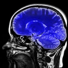 Gehirn: Ultraschall erlaubt gezielte Behandlung von Parkinson.