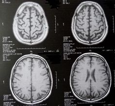 Gehirnscans: machen Verhaltensstörungen sichtbar. Bild: pixelio.de, D. Schütz