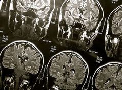 Gehirn-Scans: Chip steckt bald direkt im Gehirn. Bild: flickr.com/wyinoue