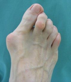 Hallux valgus