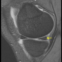Riss im Innenmeniskus-Hinterhorn (siehe Pfeil, Ansicht von der Seite). Das Vorderhorn ist intakt