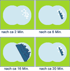 Bild 1: Beispiel einer typischen Migräne-Aura in der rechten Gesichtshälfte (Quelle: http://www.naramig.de/nar_all_ver_mig_in.htm).