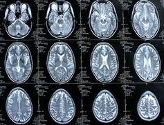 Gehirn-Scans: deutlich mehr Tumore bei Akademikern. Bild: pixelio.de, Rike
