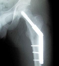Hüftimplantat im Röntgen: Metall ist schlechtestes Material. Bild: Wikimedia