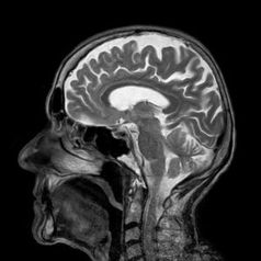 Gehirn-Röntgen: Blutversorgung verschlechtert sich.