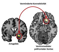 Neuronale Mechanismen der Einprägung negativer Erfahrungen: Passend zu tierexperimentellen Daten mit Knock-Out Mäusen zeigen gesunde Versuchspersonen mit natürlich vorkommenden Varianten des Dynorphin-Gens eine vermehrte Aktivität in der Amygdala während des Vergessens sowie eine verminderte Kopplung zwischen Amygdala und ventromedialem präfrontalen Kortex.
Quelle: (c) Abbildung: Susanne Erk (idw)