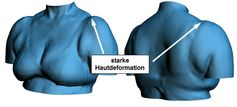 Hautdeformation im Schulterbereich am Beispiel der Größe 80 C, Altersgruppe zwischen 60 und 70 Jahre
Quelle: © Hohenstein Institute (idw)