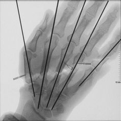 Die geröntgte Hand nach der Operation.  Bild: Bundeswehr Fotograf: Presse- und Informationszentrum des Sanitätsdienstes der Bundeswehr