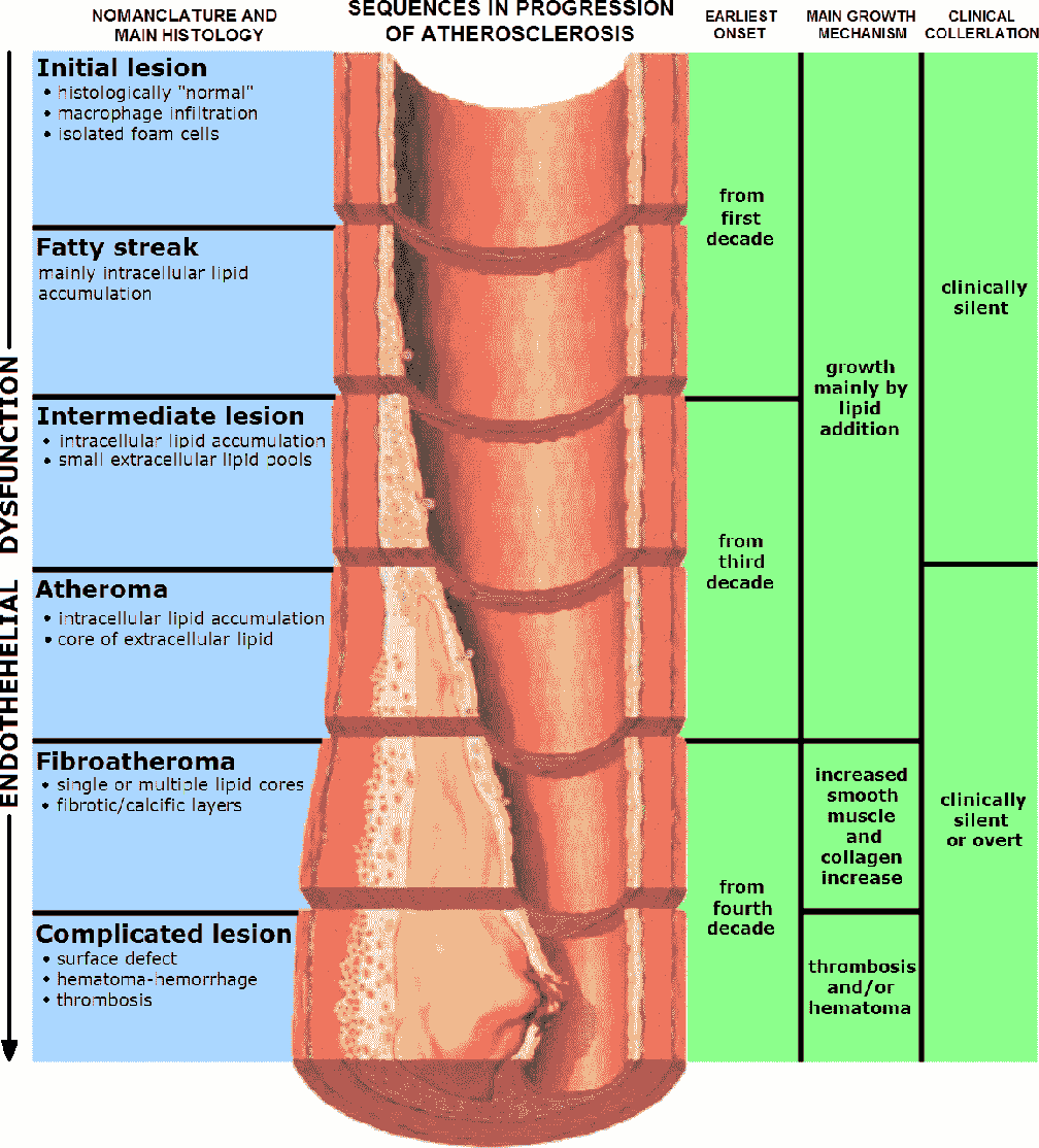 Schematisch: Phasen der Atherosklerose