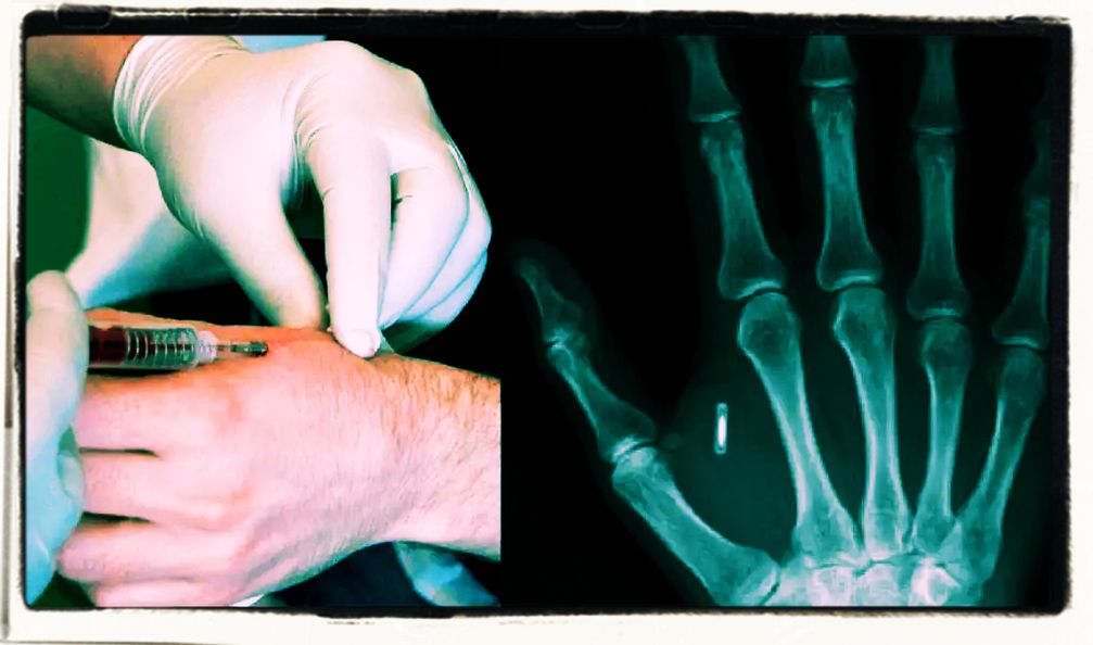 Mikrochips werden beispielsweise in die Hand implantiert.