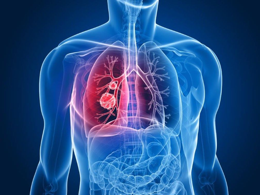 Neue-Option-f-r-Lungenkrebspatienten-Innovative-Therapie-mit-elektrischen-Wechselfeldern-jetzt-CE-zertifiziert