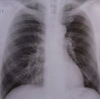 Röntgenbild der Lunge: Mehr Frauen von Krebs betroffen. Bild: pixelio.de/Schütz