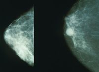 Gesunde Brust (links) und Mammakarzinom (rechts)