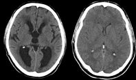 links CT eines Hydrocephalus internus; rechts zum Vergleich ein normales Gehirn.