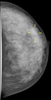 In der Mammographie einer dichten Brust ist das Karzinom kaum zu erkennen