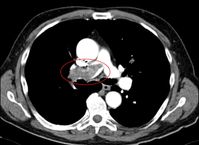 Lungenembolie mit Nachweis eines großen Thrombus innerhalb der rechten Pulmonalarterie