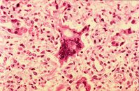 Riesenzelle bei Masernpneumonie im feingeweblichen Schnitt