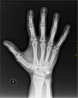 Röntgenbild einer menschlichen Hand