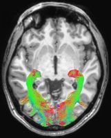 Gehirn-Scan: Strukturen verändern sich frühzeitig. Bild: rsna.org