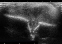Ultraschallschnitt eines eosinophilen Granulomes am Schädel bei einem 1 jährigen Kind mit großem Weichteiltumor und deutlich kleinerer, unterminierender Destruktion der äußeren Teile der Schädelkalotte