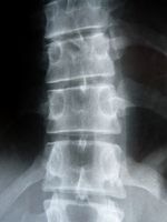 Rückenschmerzen: Paracetamol hilft nicht. Bild: pixelio.de, Dieter Schütz