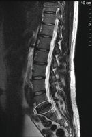 MRT-Aufnahme eines Bandscheibenvorfalls in der Lendenwirbelsäule