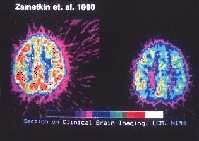 In einer 1990 von Zametkin und Mitarbeitern durchgeführten Studie wurde der Glucose-Stoffwechsel des Gehirns bei erwachsenen ADHS-Patienten und gesunden Kontrollpersonen verglichen. Die PET-Aufnahme zeigt links den zerebralen Glukoseverbrauch einer Person ohne ADS und rechts einer Person mit ADS bei einer bestimmten Aufgabenstellung. Die Studie war die erste große funktionell-bildgebende Untersuchung zur ADHS und bildete die Grundlage für viele weitere Studien. Die spezifischen Befunde konnten in nachfolgenden Studien allerdings nur teilweise reproduziert werden.