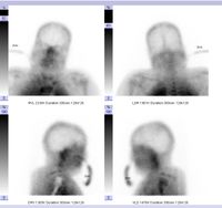 Hirntod: Fehlende Hirnperfusion in der Hirnperfusionsszintigrafie